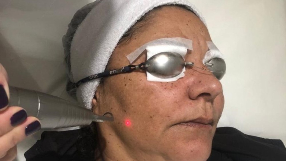 Testamos: Spectra Melasma na clínica Amilton Macedo