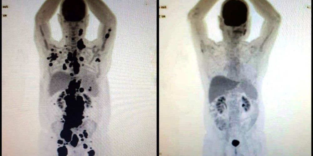 Entenda como funciona a terapia celular CAR-T Cell contra o câncer