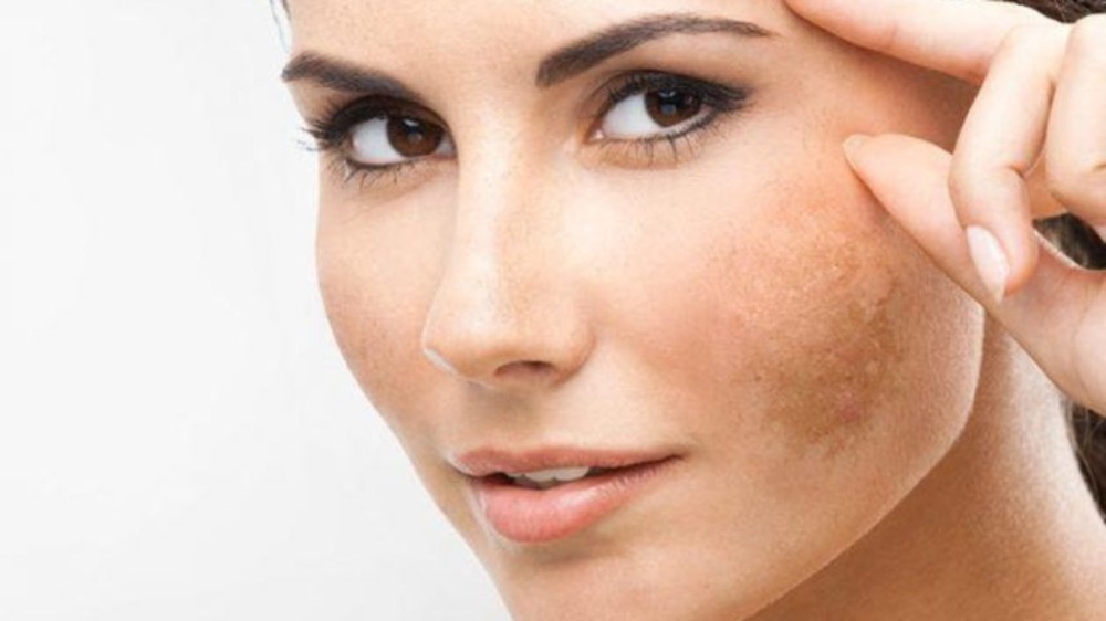Guia do melasma: como lidar com as manchas escuras na pele