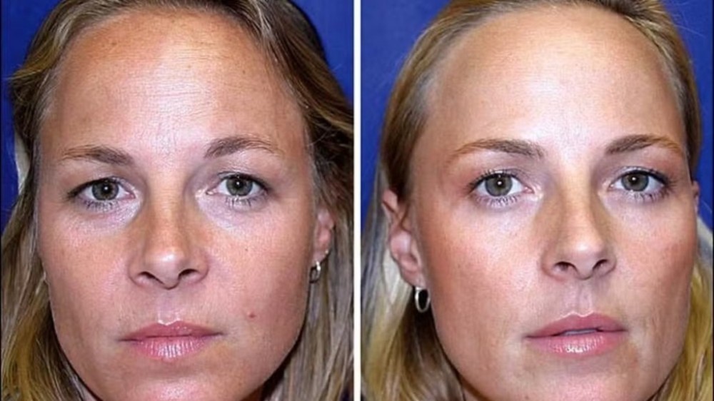 Botox: Estudo compara gêmeas, uma usou por 19 anos, a outra não