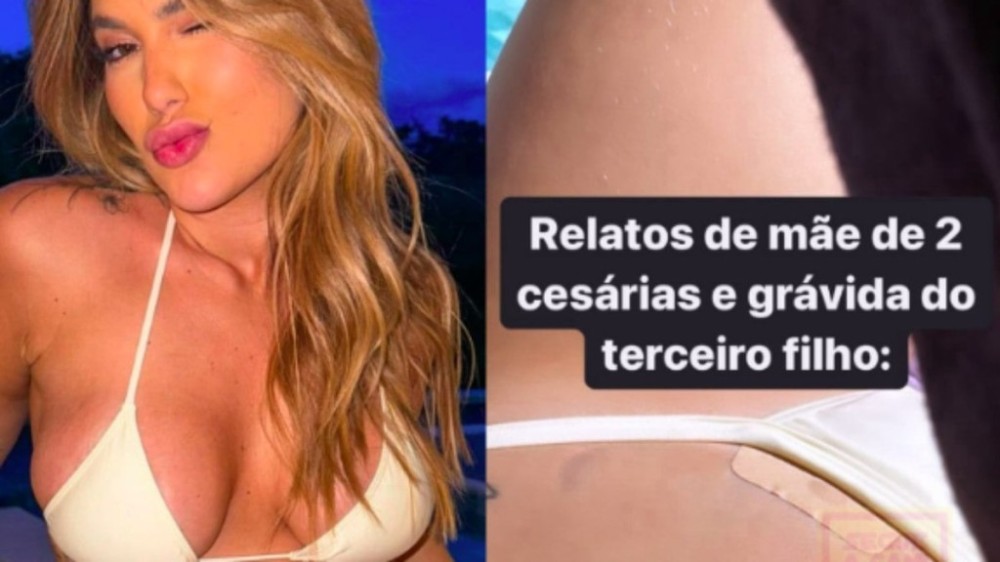 Grávida do terceiro filho, Virginia mostra ponto inflamado de cesárea