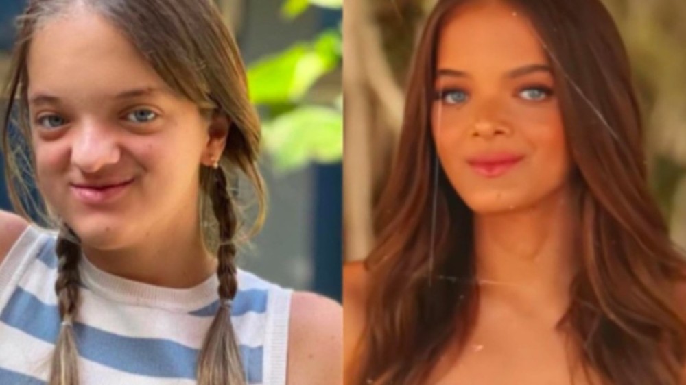 Rafa Justus: adolescente pode fazer plástica? Tire suas dúvidas